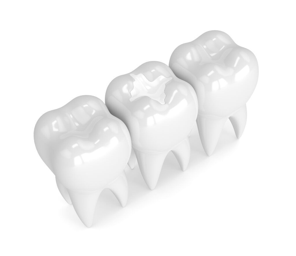 White Fillings vs Silver Fillings Everything You Need to Know Maple Mews Dental Office